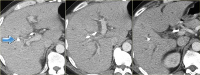 Klatskin Tumor. Barely visible. Stent in situ (arrow)