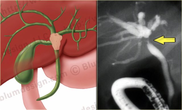 Bismuth-Corlette type II tumor with extention into the origin of the right and left hepatic duct.