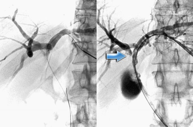 Bismuth-Corlette type IIIa Klatskin-tumor