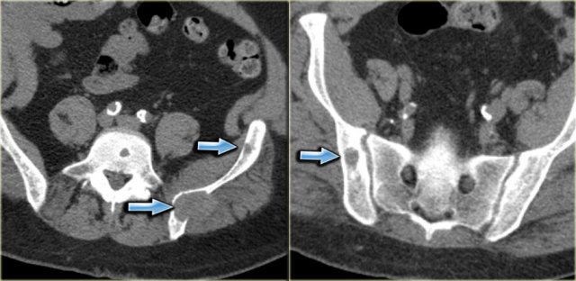 Brown tumors in HPT