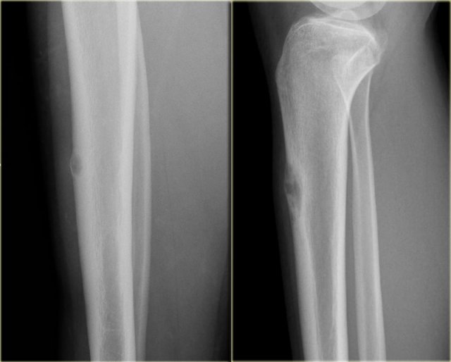 ABC versus Adamantinoma. Notice resemblance between intracortical ABC in tibia (left) and Adamantinoma (right).