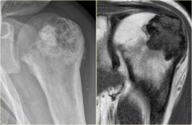 Chondroblastoma in proximal humerus