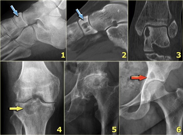 Degenerative cysts. 