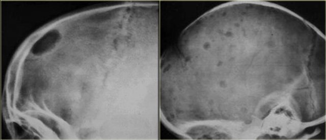 Monostotic and polyostotic eosinophilic granuloma in the skull