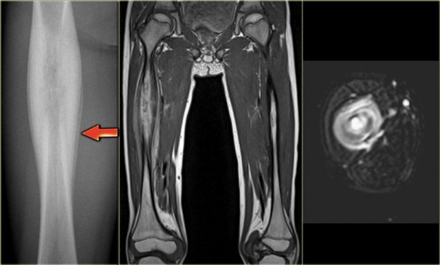 EG in the femur