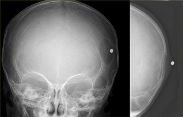 Eosinophilic granuloma in the skull