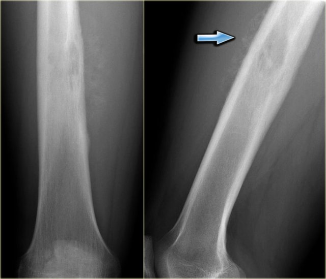 Ewing sarcoma