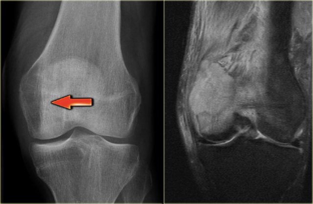 Metastasis in distal femur