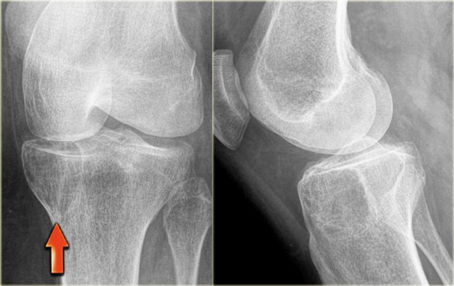 Giant cell tumor in the tibia abuts the articular surface