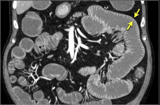 Normal bowel wall enhancement.