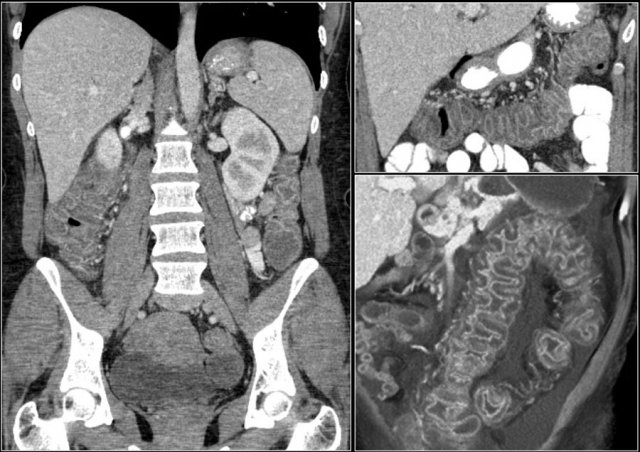 Pseudomembranous colitis