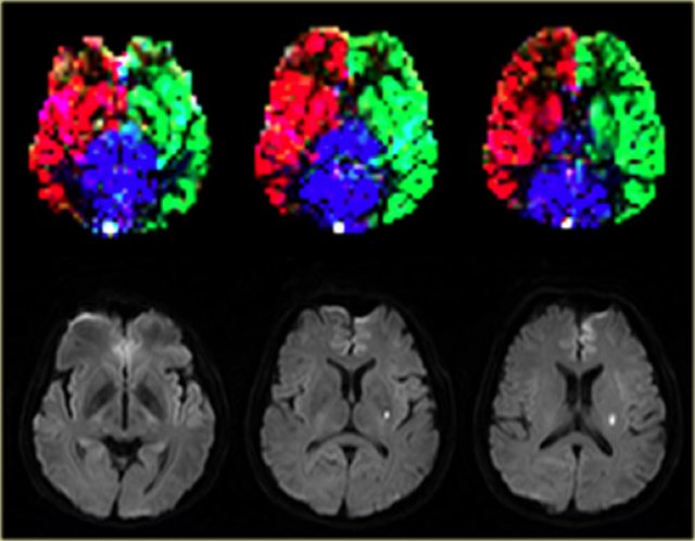 Normal perfusion territories in a patient with a lacunar infarction Images courtesy Jeroen Hendrikse (9)