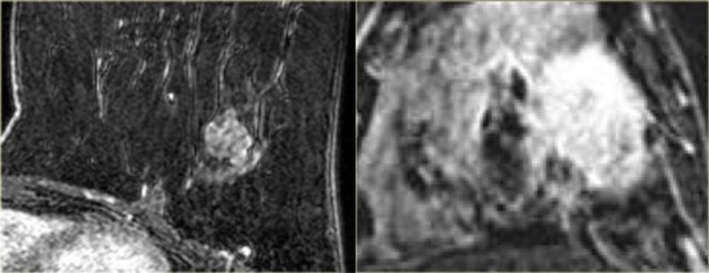 LEFT: Fibroadenoma with non-enhancing septations. RIGHT: Invasive carcinoma with enhancing septations