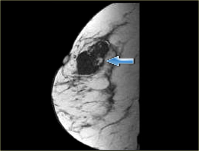 Fat-containing hamartoma with central high signal on T1WI (arrow)