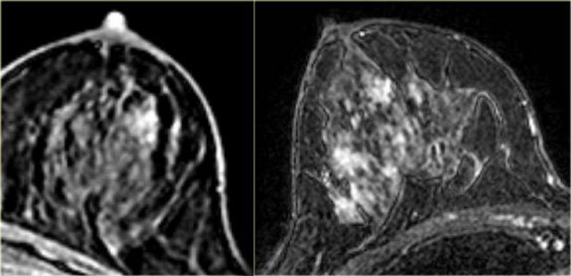 Clumped enhancement  in DCIS