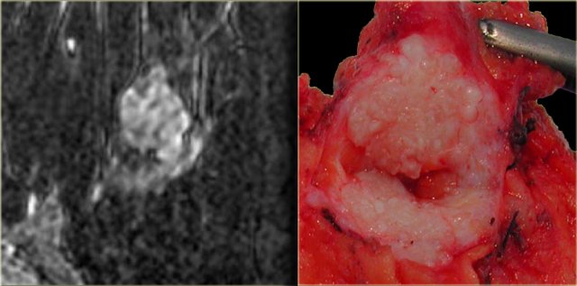 Fibroadenoma with nonenhancing septations