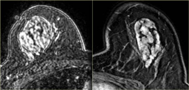 Two examples of a hamartoma with dark areas of fat on a fat suppressed T1WI with Gd.