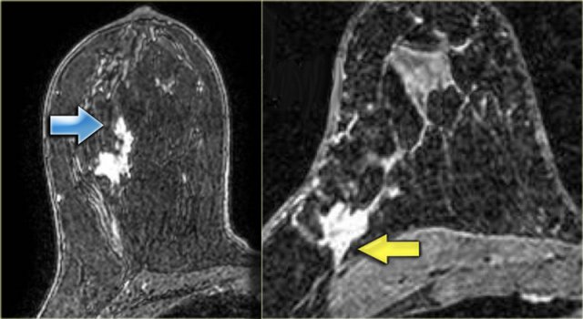 Two cases of intraductal carcinomas