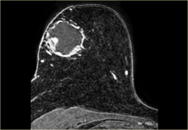 Metaplastic carcinoma