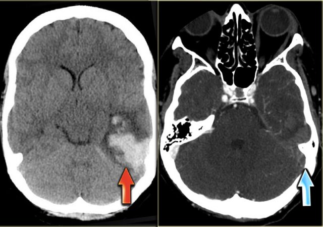 Hemorrhagic venous infarct in Labbe territory