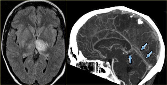 Venous thrombosis of vein of Galen and straight sinus