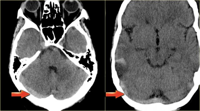 Normal transverse sinus (left) and thrombosed transverse sinus (right).