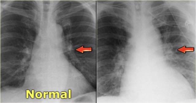 Perihilar haze in interstitial stage of CHF