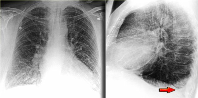 Pleural effusion more evident on lateral view