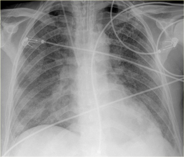 Normal VPW in a patient with ARDS