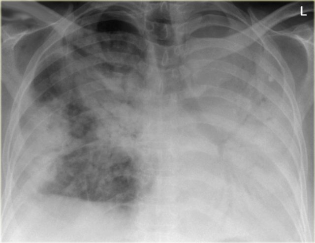 Diffuse consolidation in a patient with bronchoalveolar carcinoma