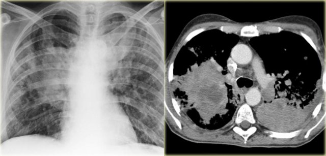 Non Hodgkin lymphoma