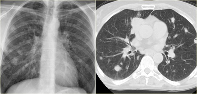 Metastases in a patient with a head-neck cancer