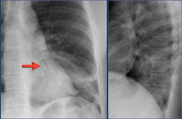 Lobar pneumonia