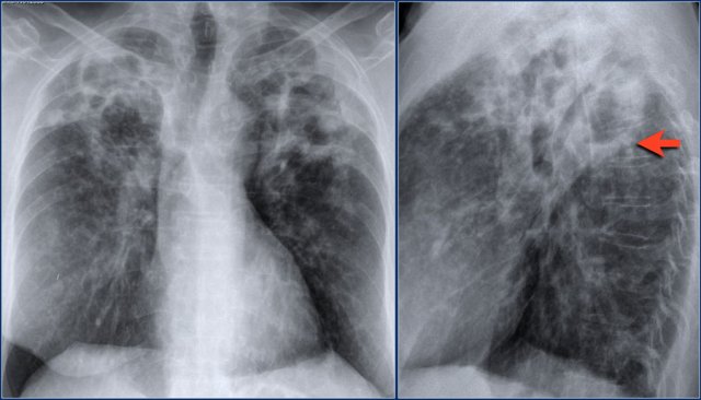 Nontuberculous mycobacteria pneumonia with cavitation