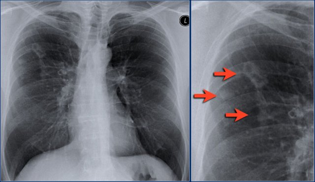 Nontuberculous mycobacteria infection with cavitation