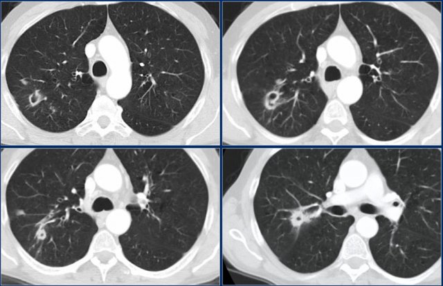 Nontuberculous mycobacteria infection with cavitation