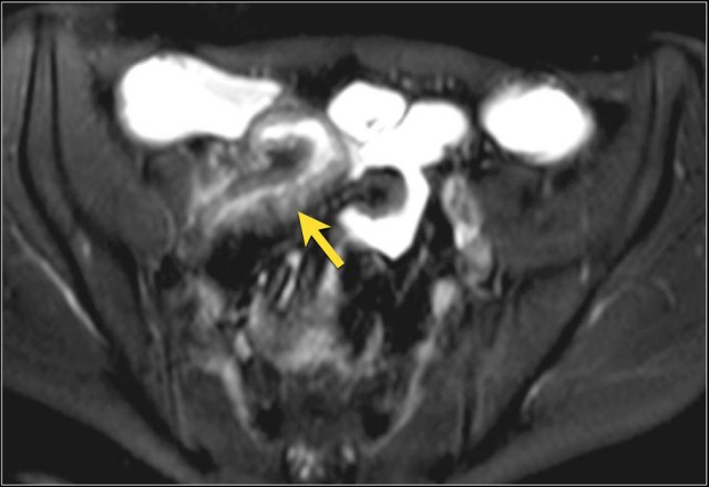 Actively inflamed terminal ileum with marked thickening and moderate mural signal intensity (mural edema) on an axial T2 with fat sat.