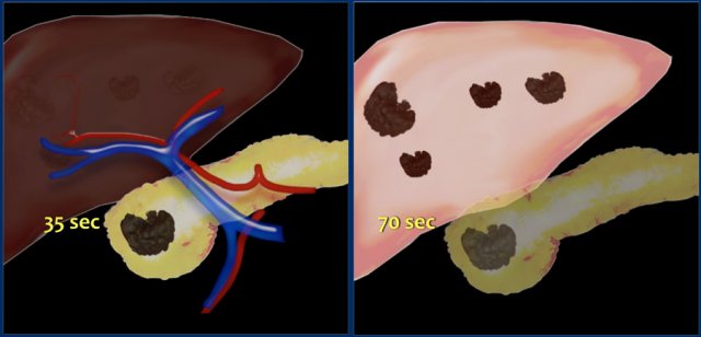 Pancreatic carcinoma is best imaged at 35 sec p.i. Liver metastases are best imaged at 70 sec p.i.