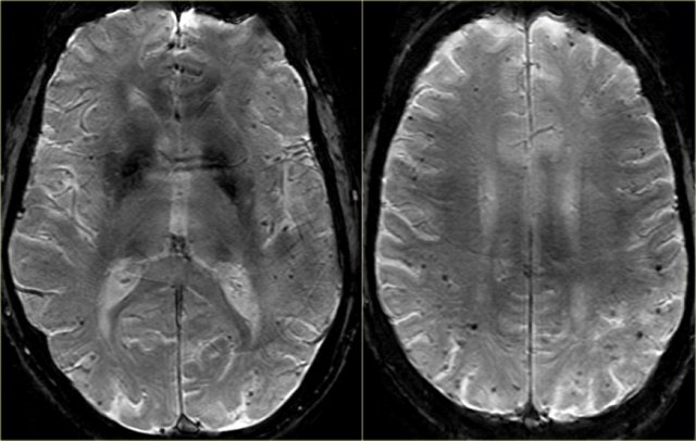 Cerebral Amyloid Angiopathy