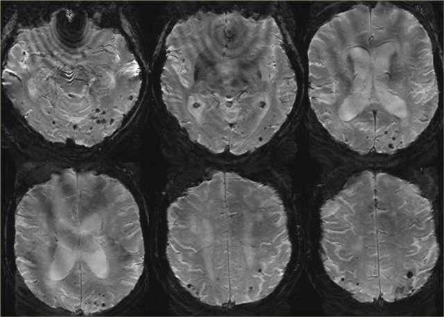 Cerebral Amyloid Angiopathy