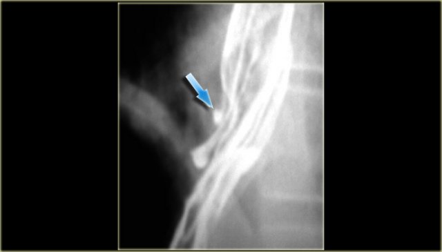 Barrett's esophagus with ulcerated (arrow) adenocarcinoma