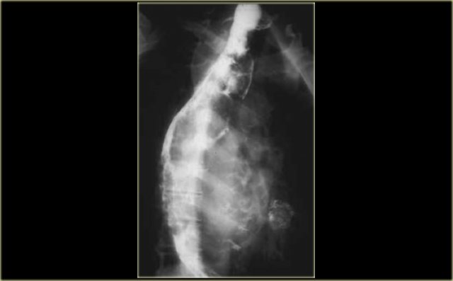 Spindle cell carcinoma