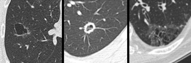 Examples of cystic lung cancer