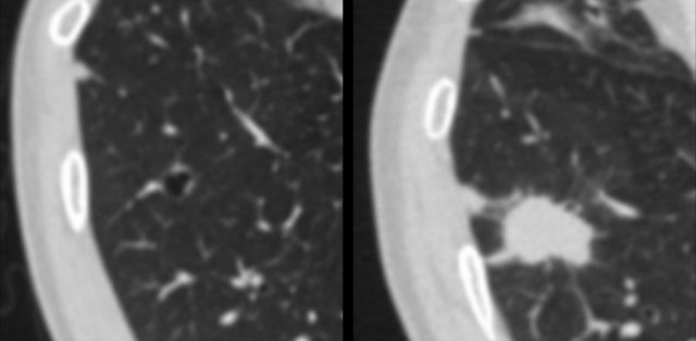 Cystic lung cancer demonstrating ‘solidification’