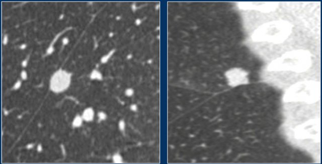 Non-PFN nodules. Courtesy of M. Prokop