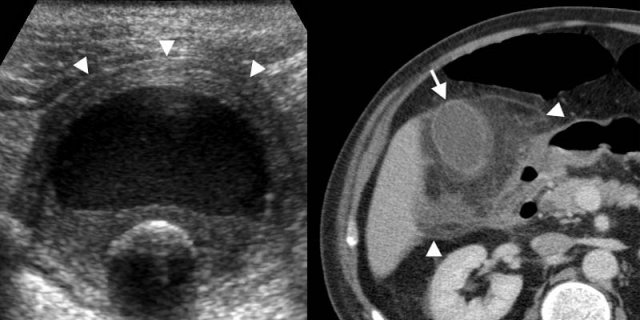 Acute calculous cholecystitis