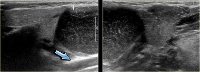 Second branchial cleft cyst