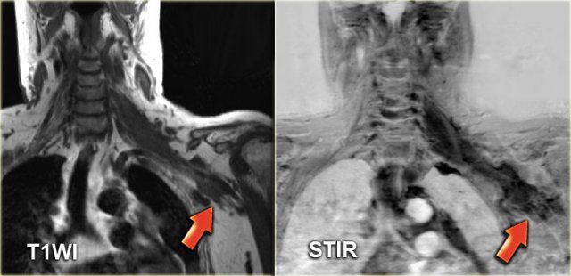 Recurrent NHL with diffuse infiltration of the left brachial plexus