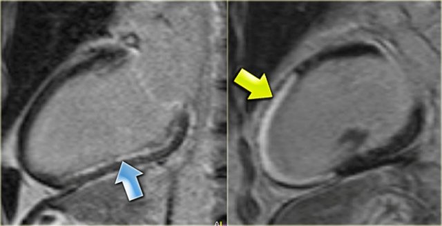 Left: subendocardial infarction, Right: transmural infarction