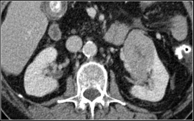 Oncocytoma in left kidney with central scar